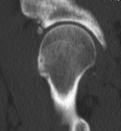 Hip CT Anterior Cam Lesion